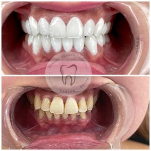 zirconium case 
before and after 